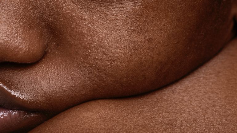 Peau mixte : comment en prendre soin naturellement